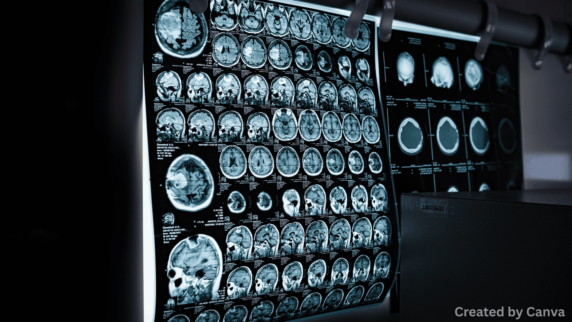 Rear-End Collision MRI: When You Need One (And When You Don’t)