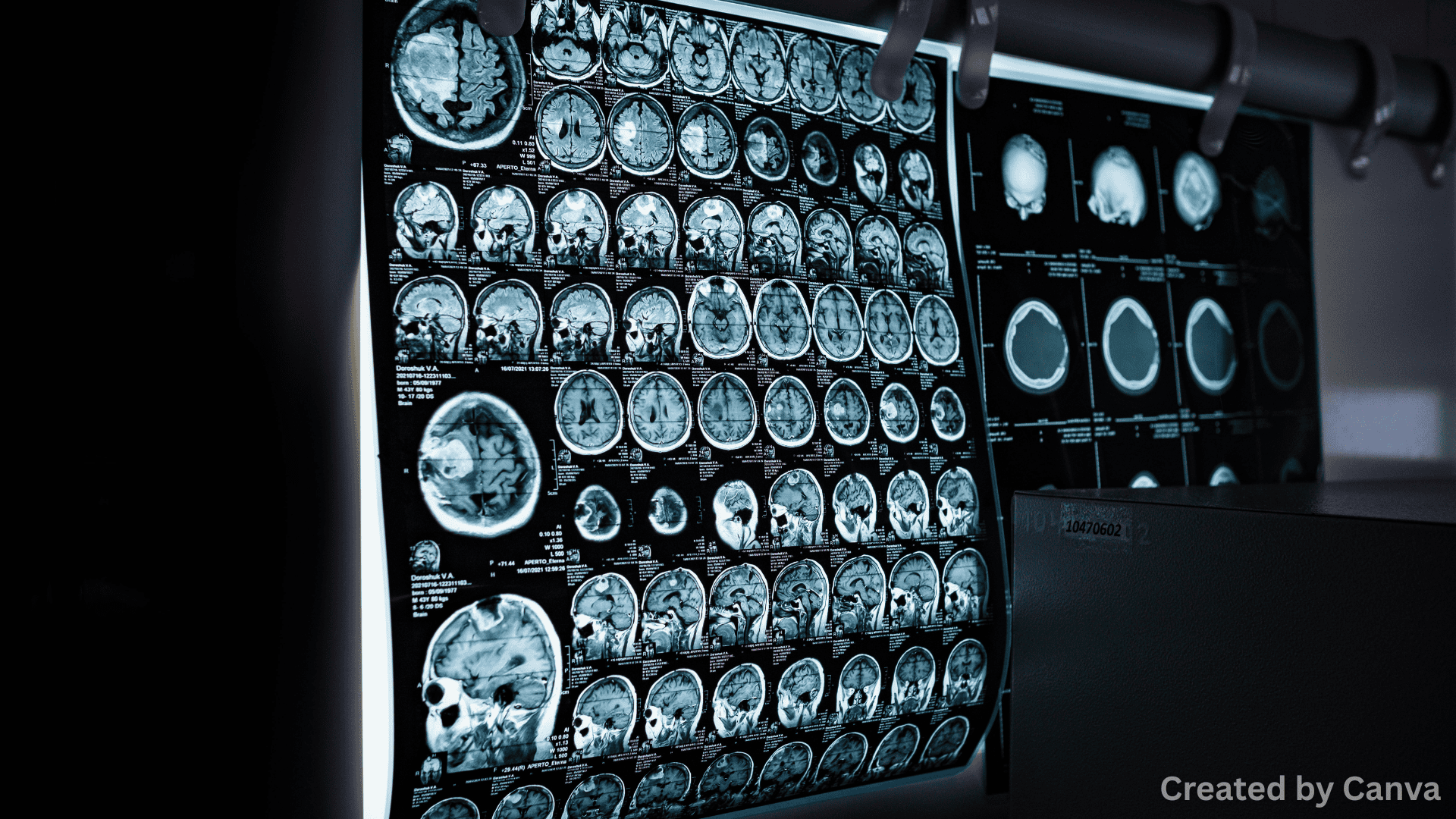 How to Determine if You Need an MRI After a Rear-End Accident